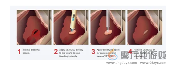 10秒内止血堪比游戏道具！美国FDA批准止血凝胶上市(图2)